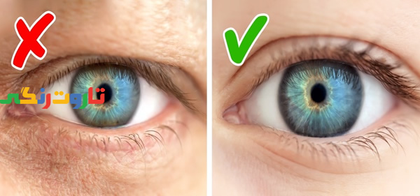 چین و چروک و گودی پشت پلک چشم, پیری زودرس, علائم پیری زودرس, نشانه های پیری زودرس, پیشگیری از پیری زودرس, جلوگیری از پیری زودرس