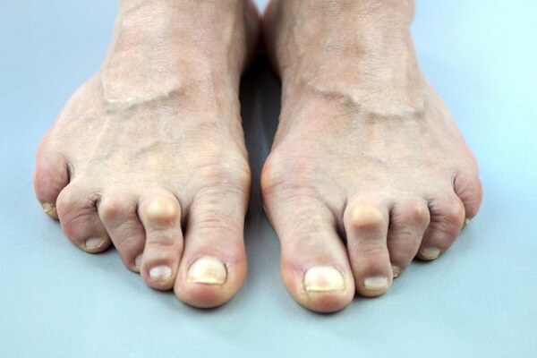 آرتروز انگشتان پا