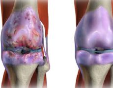 آرتروز  و هر آنچه که باید درباره آن بدانید!