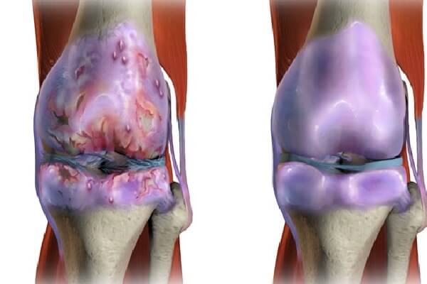 آرتروز زانو