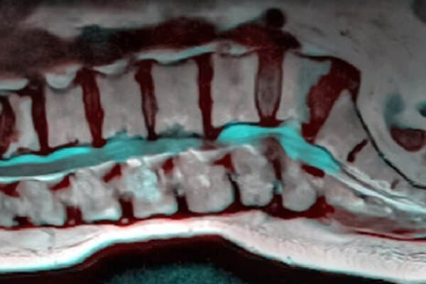 آرتروز کمر یا ستون فقرات