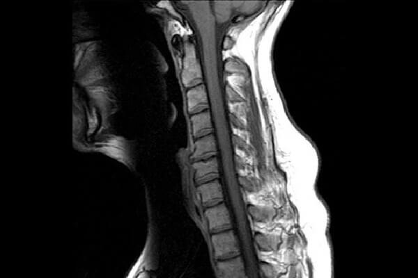 آرتروز گردن