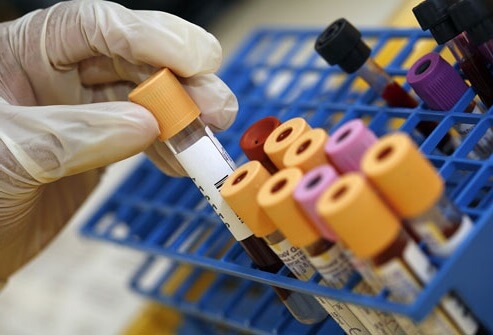 آزمایش خون برای تشخیص تیروئید