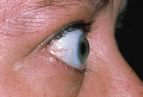 بیماری گریوز (Graves) در تیروئید پر کار