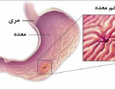 زخم معده و هر آنچه که باید درباره آن بدانید!