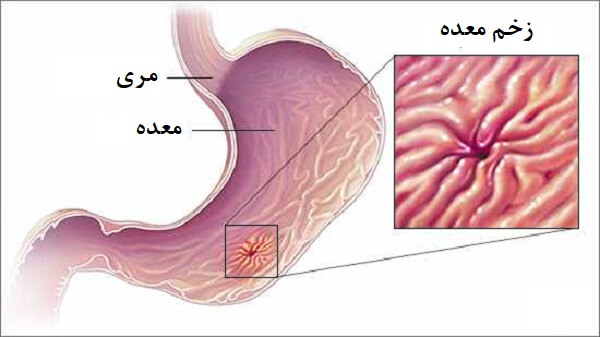 زخم معده