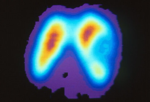 سرطان تیروئید