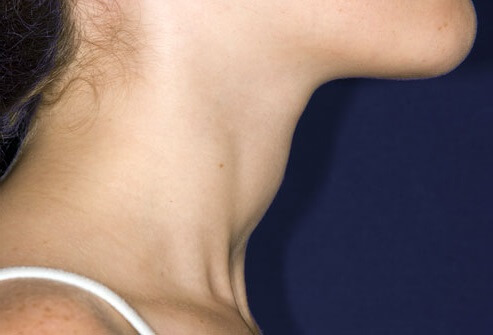 علایم تیروئید - ورم گلو