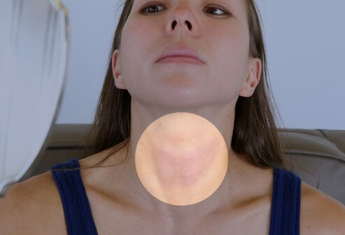 تشخیص تیروئید با ورم گردن