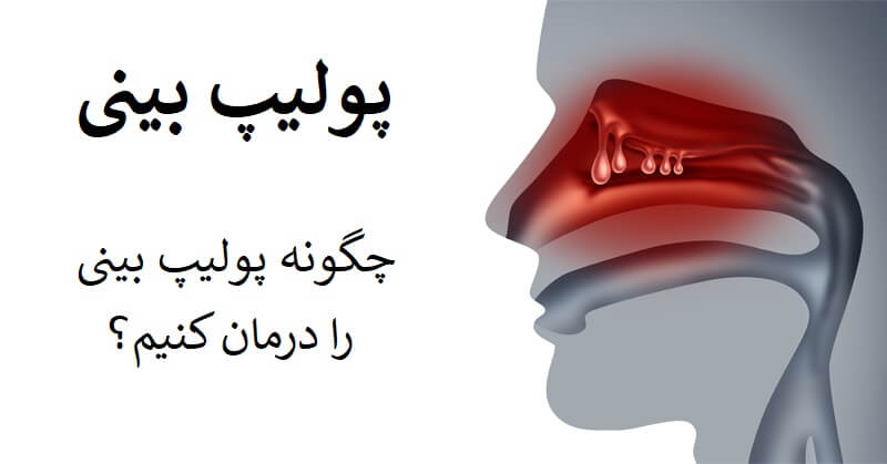 درمان پولیپ بینی