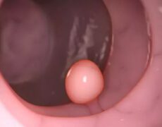 پولیپ و هر آنچه که باید درباره آن بدانید!