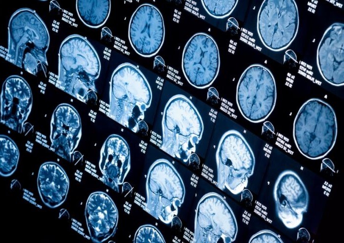 پزشک برای تشخیص خونریزی در مغز با استفاده از سی تی اسکن و ام آر آی از مغز تصویربرداری می کند.