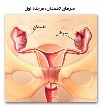 سرطان تخمدان - مرحله اول