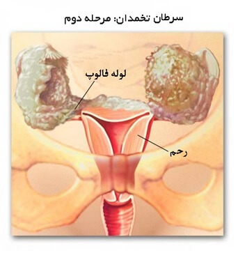 سرطان تخمدان - مرحله دوم