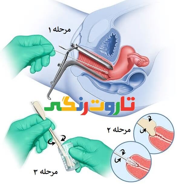 نحوه انجام تست پاپ اسمیر