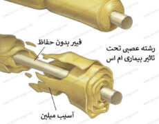 بیماری ام اس MS و هر آنچه که باید درباره آن بدانید!