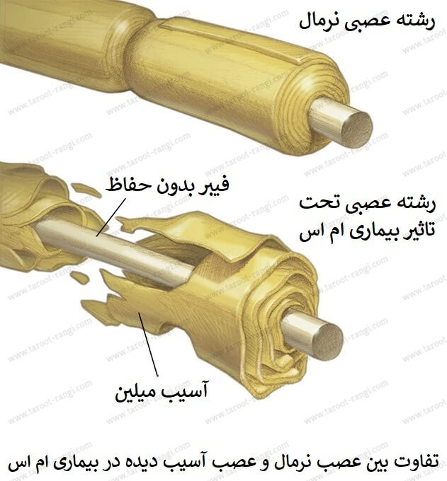 بیماری ام اس