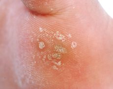 زگیل و هر آنچه که باید درباره آن بدانید!