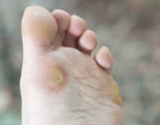 🦠 تعبیر خواب زگیل از نظر معبران معروف و موضوعات مختلف 🦠 تعبیر خواب زگیل از نظر معبران معروف و موضوعات مختلف