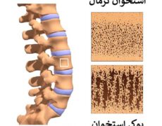 پوکی استخوان و هر آنچه که باید درباره آن بدانید!