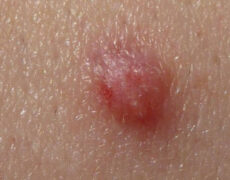 زگیل تناسلی و هر آنچه که باید درباره آن بدانید!