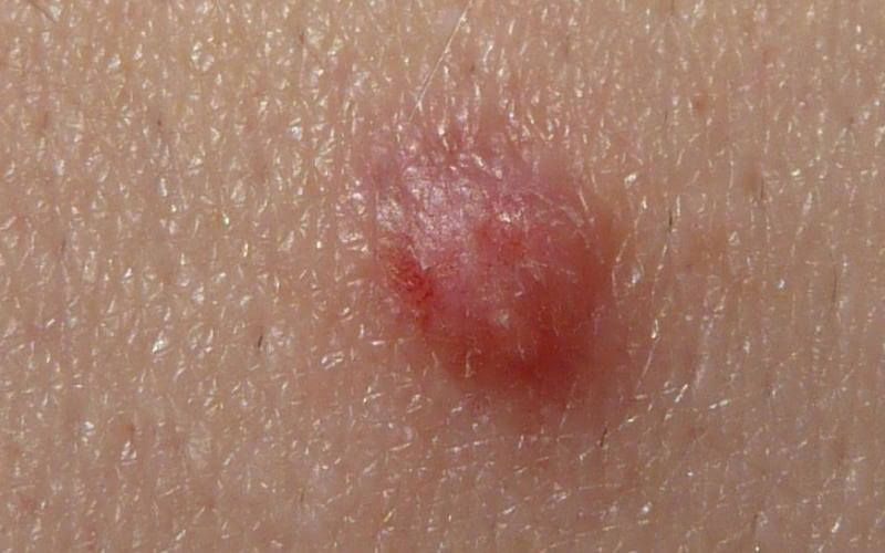 زگیل تناسلی