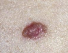 سرطان پوست و هر آنچه که باید درباره آن بدانید! سرطان پوست و هر آنچه که باید درباره آن بدانید!