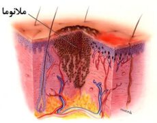 سرطان پوست ملانوما و هر آنچه که باید درباره آن بدانید! سرطان پوست ملانوما و هر آنچه که باید درباره آن بدانید!