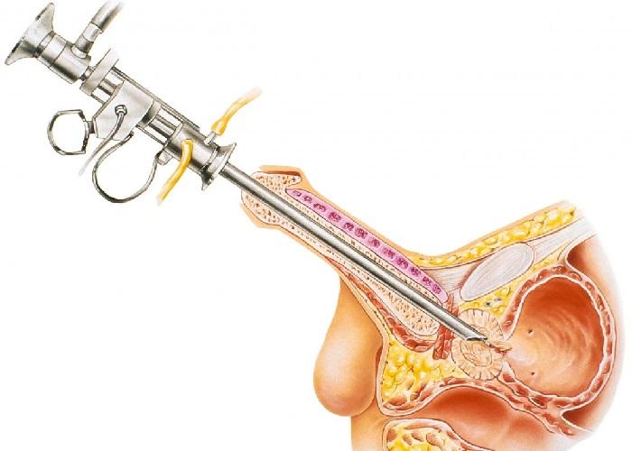 عمل جراحی خارج کردن پروستات از طریق میزراهی (TURP)