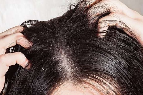 🕷️ تعبیر خواب شپش از نظر معبران معروف و موضوعات مختلف
