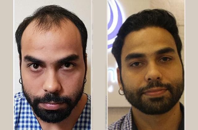 کلینیک کاشت مو ایران نوین