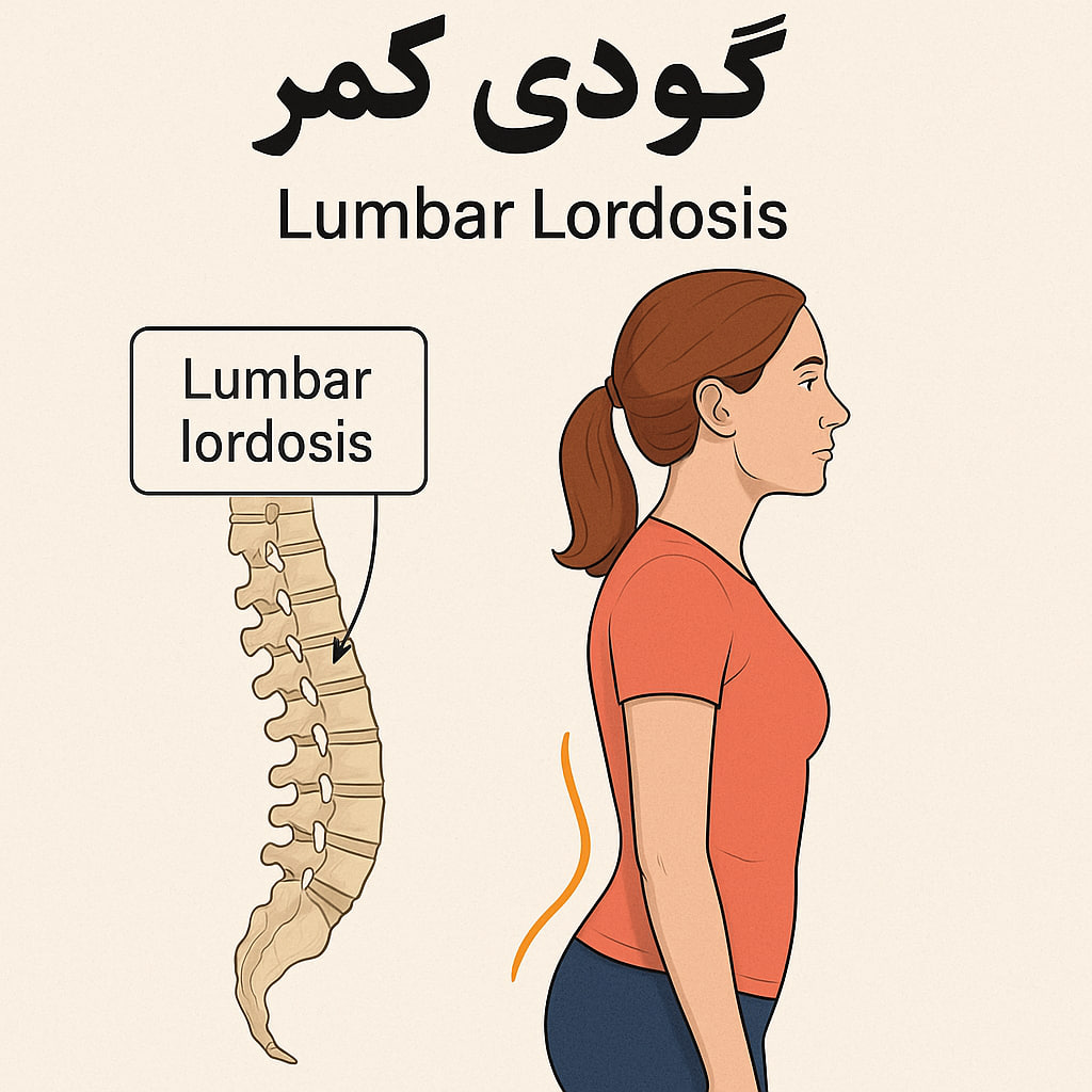 رفع گودی کمر (لوردوز): بهترین ورزشها، حرکات اصلاحی و درمانهای خانگی رفع گودی کمر (لوردوز): بهترین ورزشها، حرکات اصلاحی و درمانهای خانگی